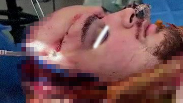 【閲覧注意】自転車事故で脳ヘルニアになった時の治療法「まずはピンセットで顔の皮をめくる」 | 閲覧注意グロ動画・衝撃映像のソルカブ