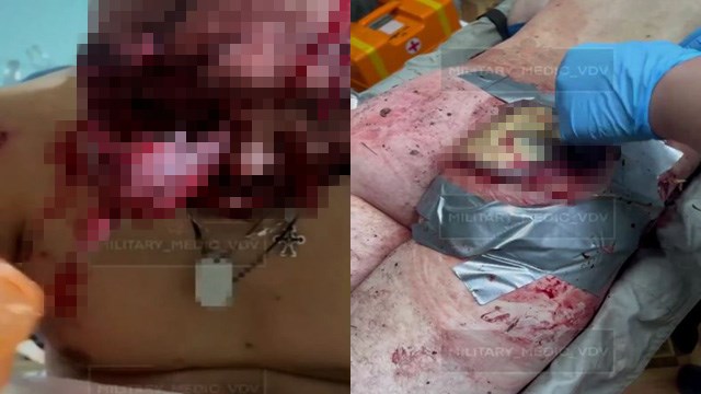 【閲覧注意】野戦病院でロシア軍医が目撃したグロすぎる重傷患者たち。 | 閲覧注意グロ動画・衝撃映像のソルカブ