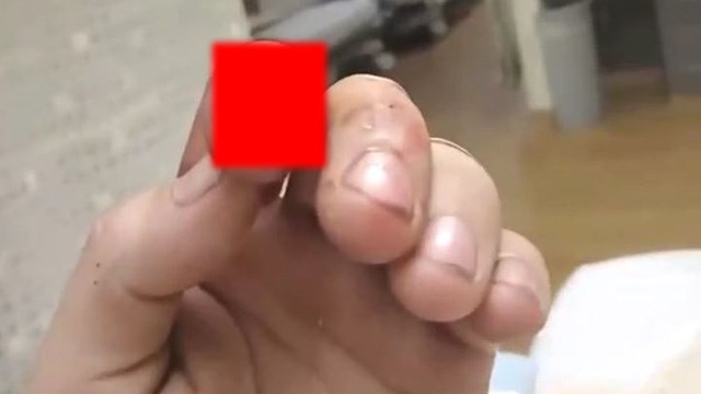 【閲覧注意】指先が鳥のクチバシみたいに割れちゃってすみません笑。っていう動画。 | 閲覧注意グロ動画・衝撃映像のソルカブ